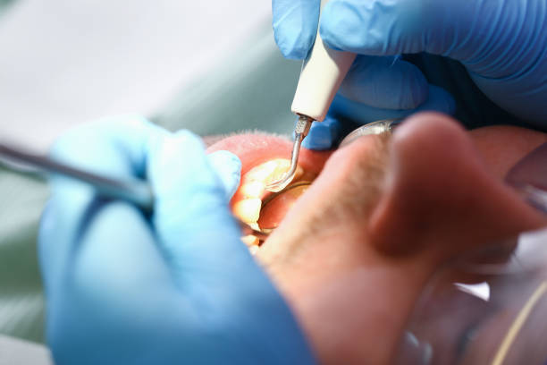 Best Emergency Dentist for Lost Fillings or Crowns in Grove City, OH