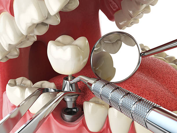 Best Emergency Dentist for Lost Fillings or Crowns in Grove City, OH